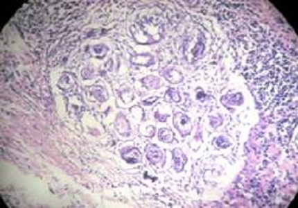 Unusual presentation of schistosomiasis as vulval polyp