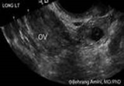 Ovarian ectopic pregnancy: a review article