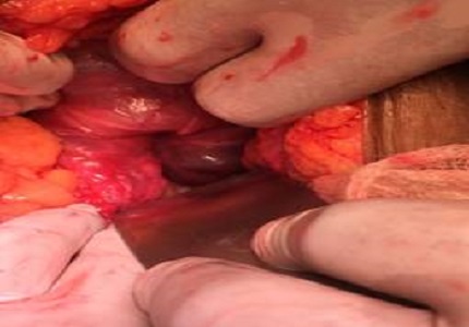 Acute inversion of a nonpuerperal uterus-a rare case