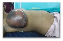 Phyllodes tumor in pregnancy: A Case Report